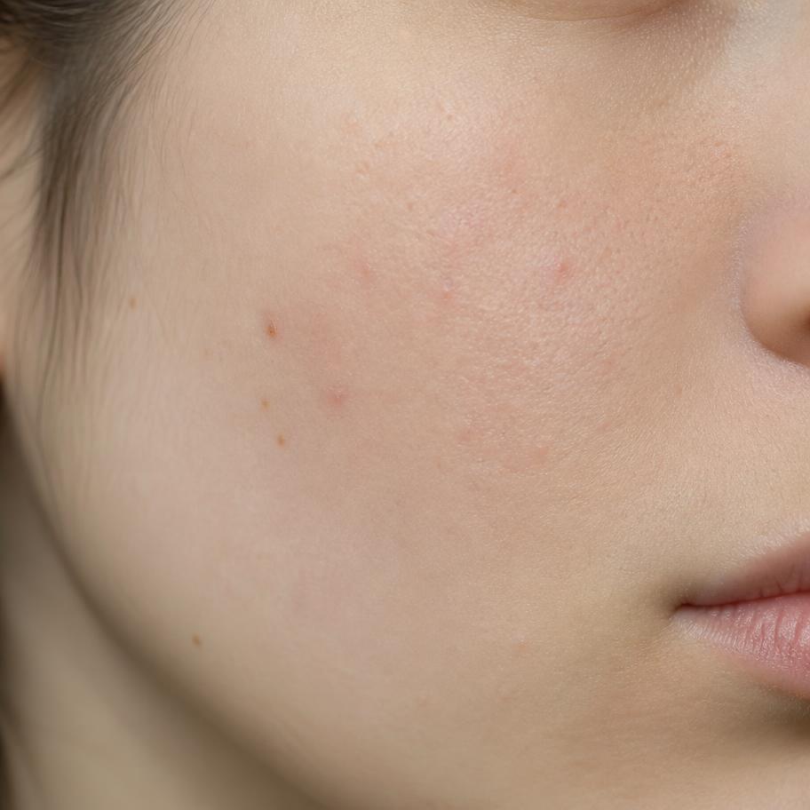 Texture de peau Acné & imperfections